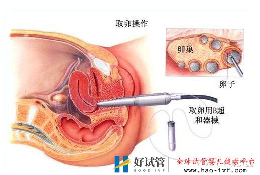 卵巢早衰做试管成功率高不高(图2)