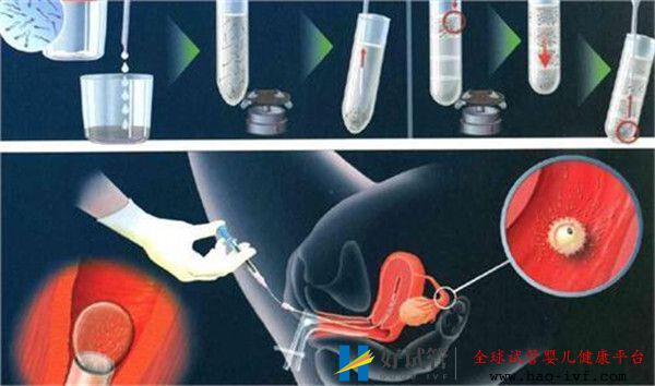 哪几类女性通过试管婴儿移植的成功率高(图1)