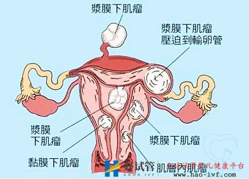 多发性子宫肌瘤可以做试管婴儿吗？你都了解吗(图1)