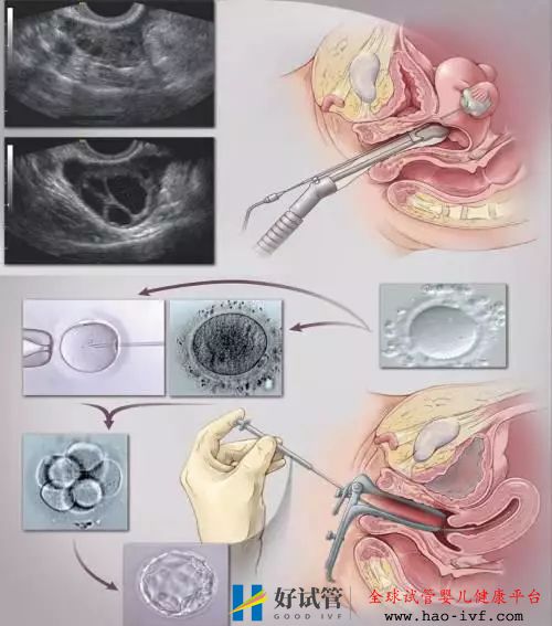 【试管流程·移植】胚胎移植流程及注意事项(图2)