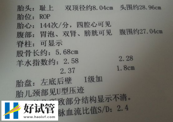 羊水过多会导致胎儿呼吸困难