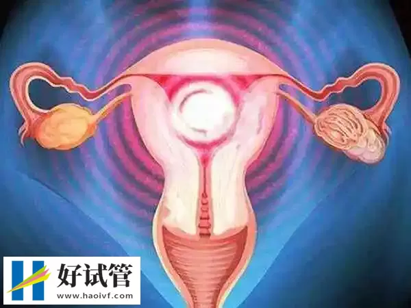 子宫腺肌症想要怀孕很不容易