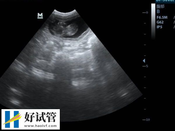 香港大学深圳医院做试管多少钱一次