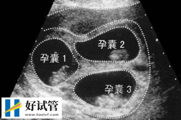 胚胎移植是将胚胎放在宫腔中