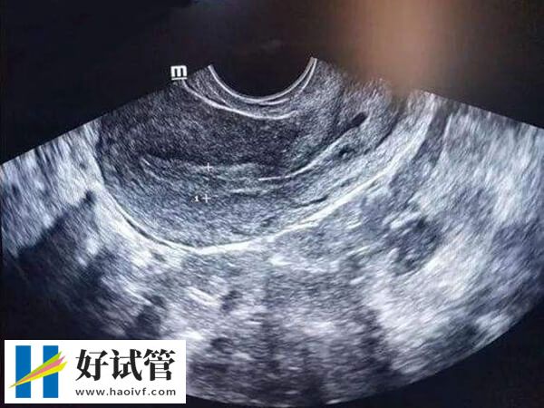 子宫内膜a型更易着床